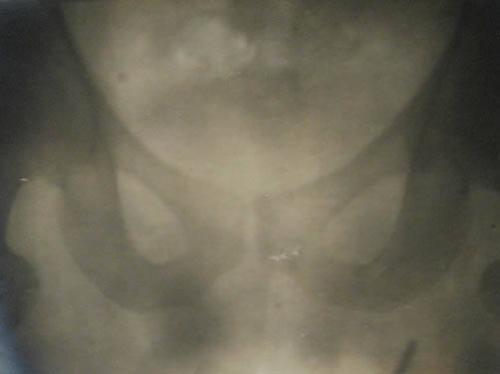 X-Ray